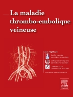 La maladie thrombo-embolique veineuse - Image principale