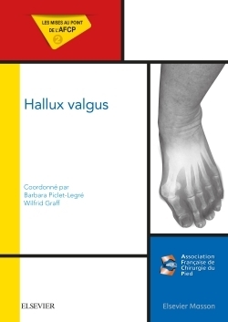 Hallux valgus - Image principale