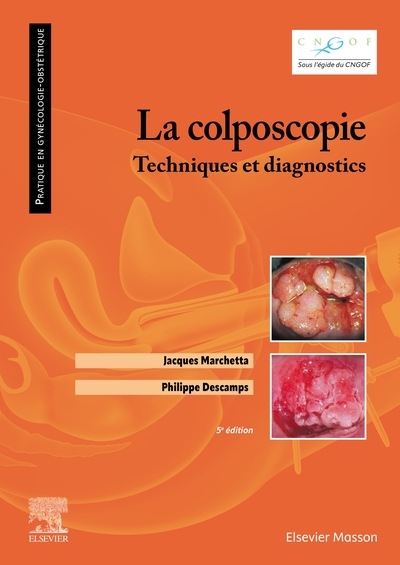 La colposcopie - Image principale