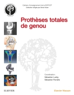 Prothèses totales de genou - Image principale