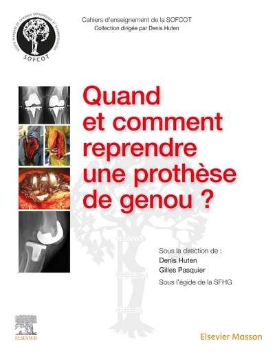 Quand et comment reprendre une prothèse de genou ? - Image principale
