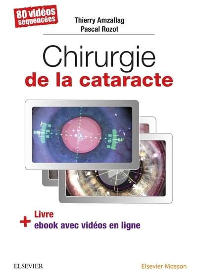 Chirurgie de la cataracte - Image principale