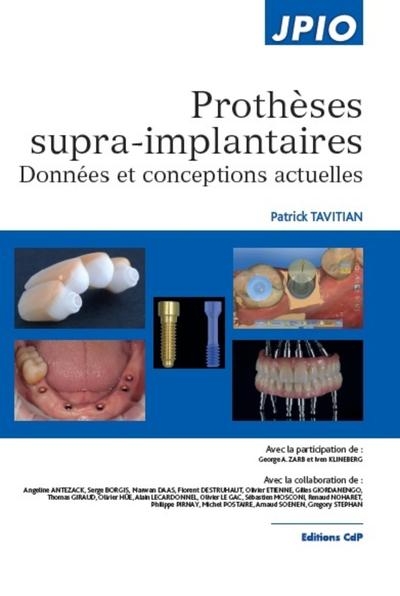 Prothèses supra-implantaires - Image principale