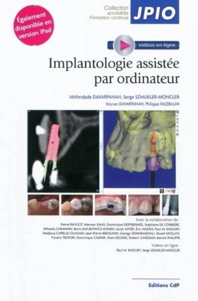 Implantologie assistée par ordinateur - Image principale