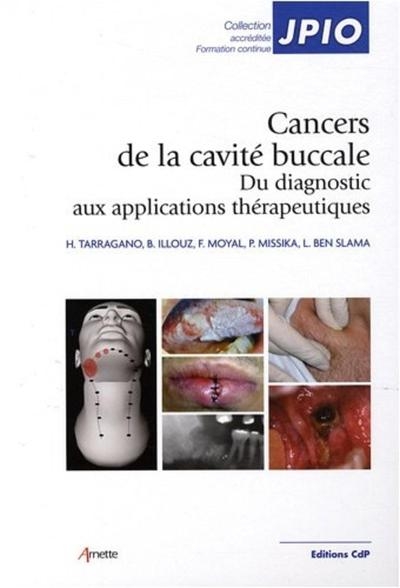 Cancers de la cavité buccale - Image principale
